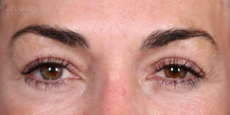 Upper Blepharoplasty Before & After Gallery - Patient 147537725 - Image 2