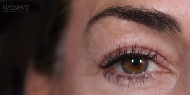 Upper Blepharoplasty Before & After Gallery - Patient 147537725 - Image 4