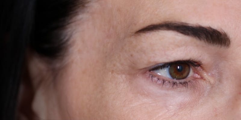 Upper Blepharoplasty Before & After Gallery - Patient 147537725 - Image 5