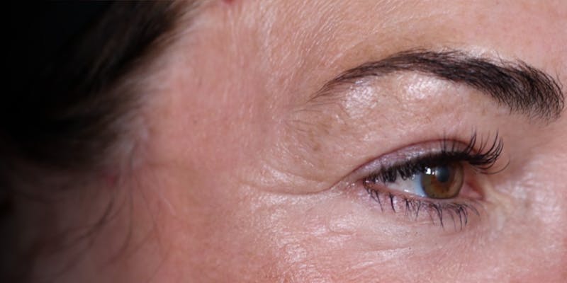 Upper Blepharoplasty Before & After Gallery - Patient 147537725 - Image 6
