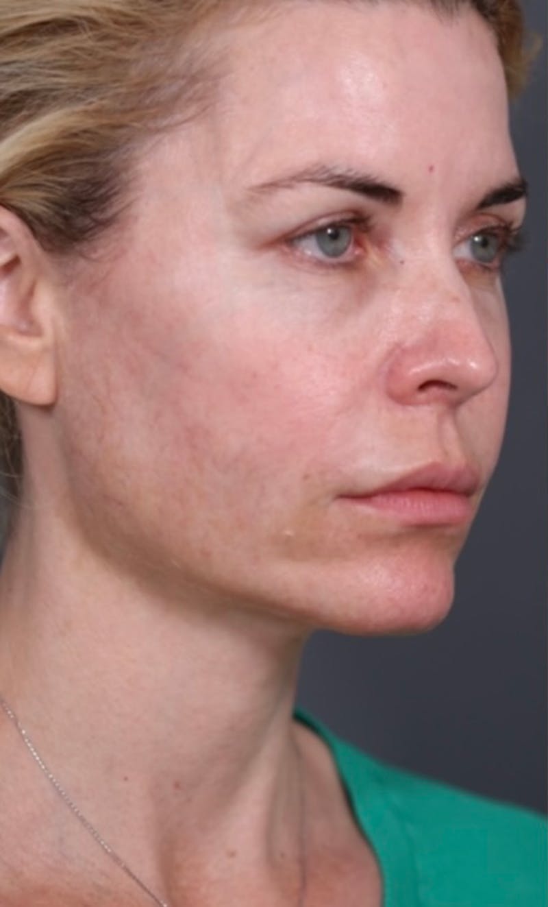 Halo Laser Before & After Gallery - Patient 147537783 - Image 1