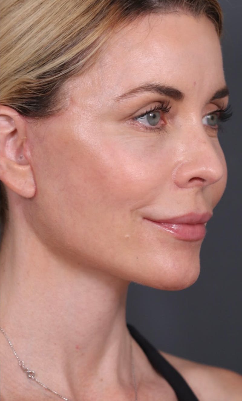 Facelift Before & After Gallery - Patient 147537775 - Image 2