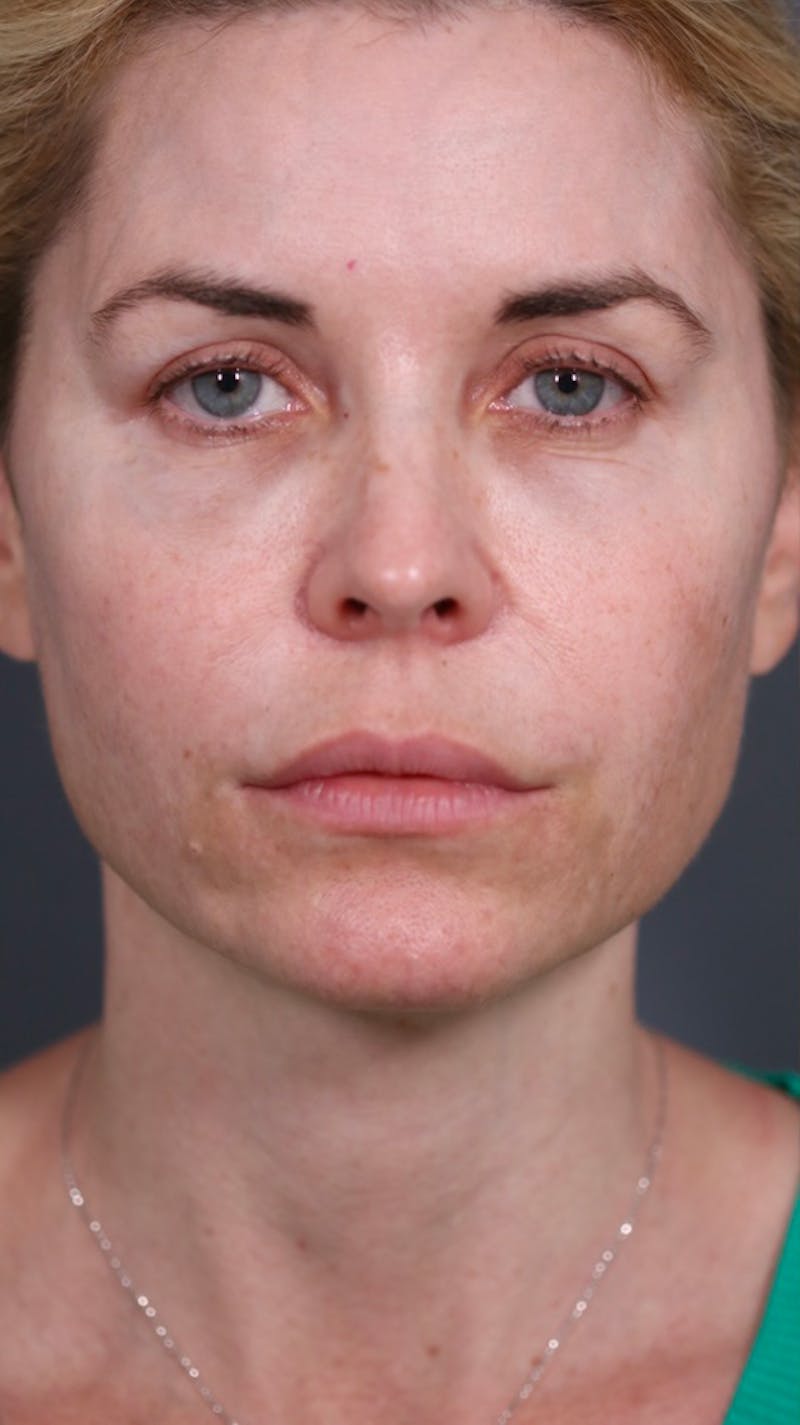 Halo Laser Before & After Gallery - Patient 147537783 - Image 3