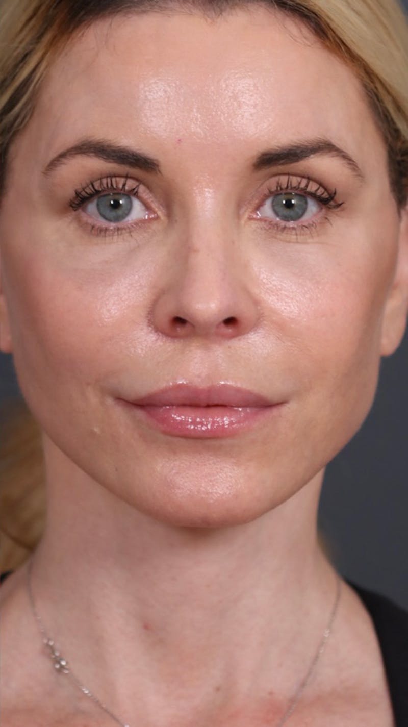 Brow Lift Before & After Gallery - Patient 147537782 - Image 4