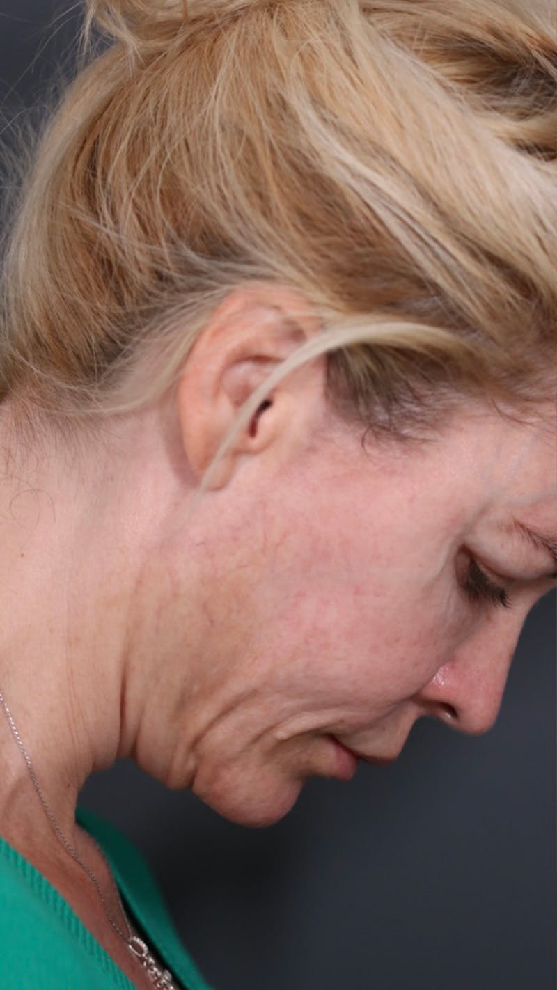 Facelift Before & After Gallery - Patient 147537775 - Image 5