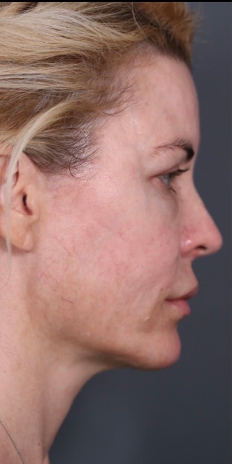 Halo Laser Before & After Gallery - Patient 147537783 - Image 7