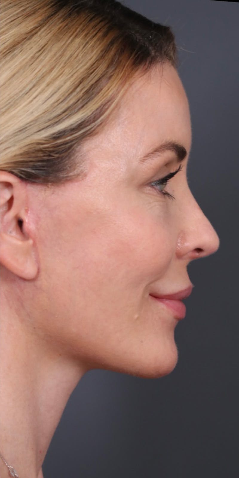 Brow Lift Before & After Gallery - Patient 147537782 - Image 8