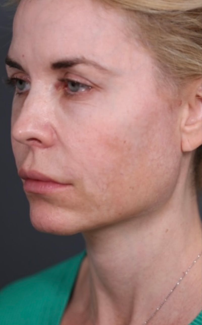 Facelift Before & After Gallery - Patient 147537775 - Image 9