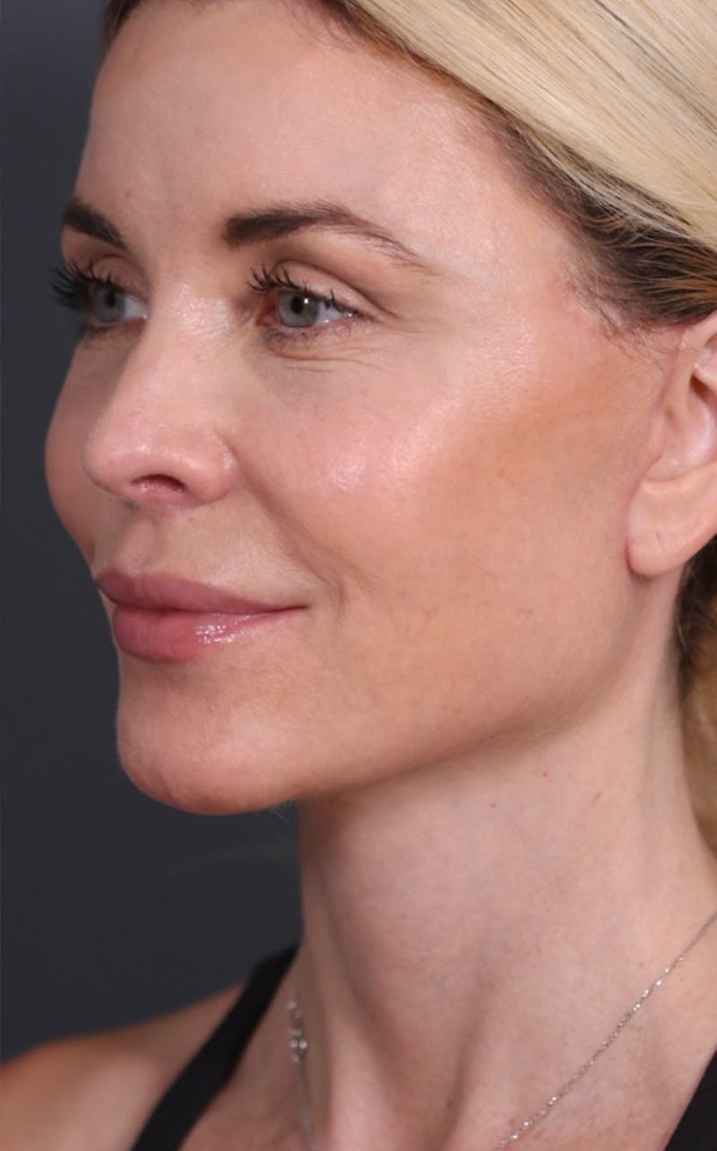 Facelift Before & After Gallery - Patient 147537775 - Image 10