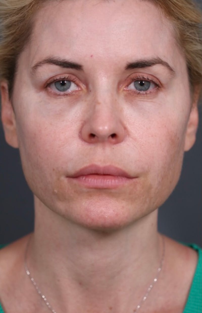 Facelift Before & After Gallery - Patient 147537775 - Image 11