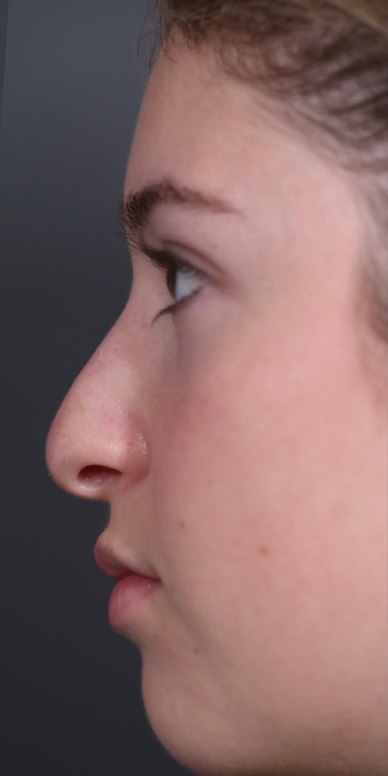 Primary Rhinoplasty Before & After Gallery - Patient 147537802 - Image 3