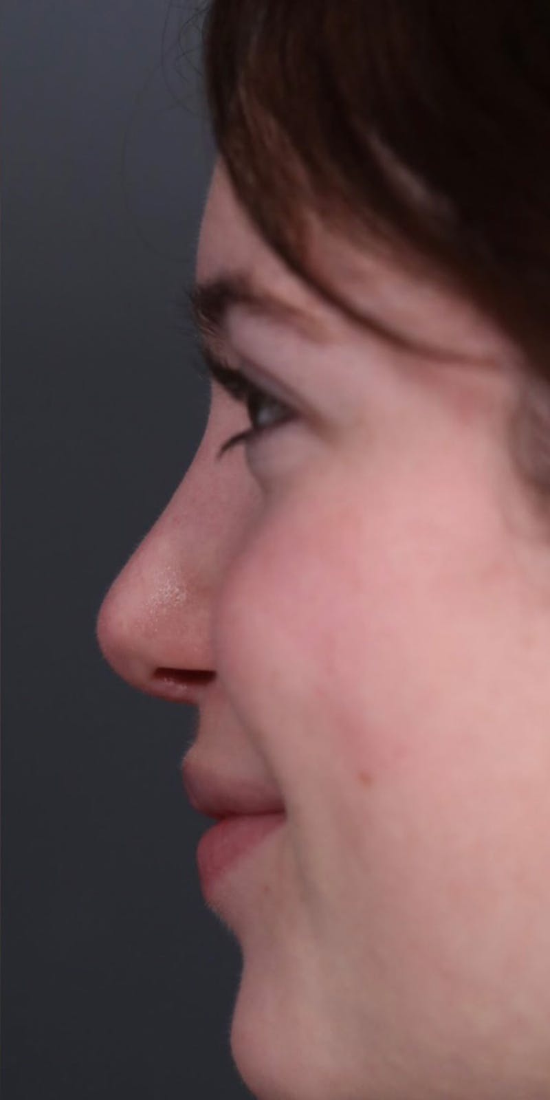 Primary Rhinoplasty Before & After Gallery - Patient 147537802 - Image 4