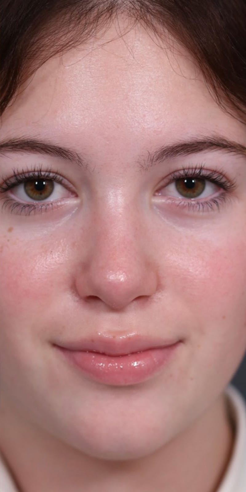 Primary Rhinoplasty Before & After Gallery - Patient 147537802 - Image 6