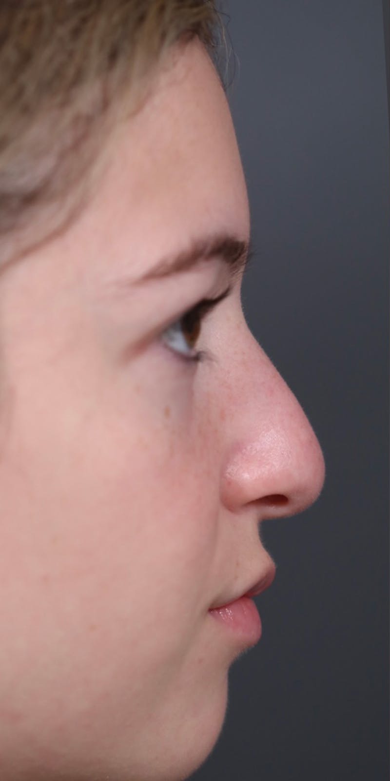 Primary Rhinoplasty Before & After Gallery - Patient 147537802 - Image 1