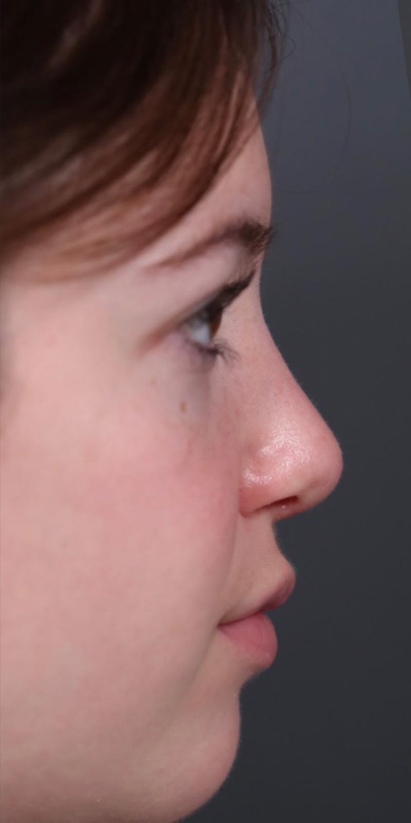 Primary Rhinoplasty Before & After Gallery - Patient 147537802 - Image 2