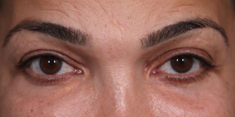 Upper Blepharoplasty Before & After Gallery - Patient 147538254 - Image 1