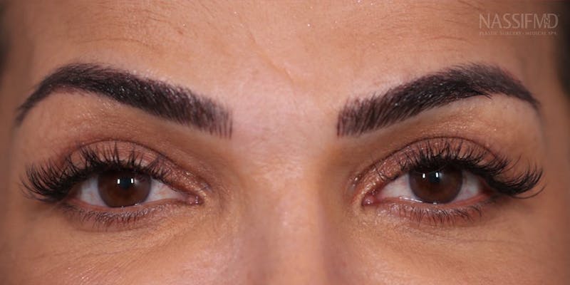 Upper Blepharoplasty Before & After Gallery - Patient 147538254 - Image 2