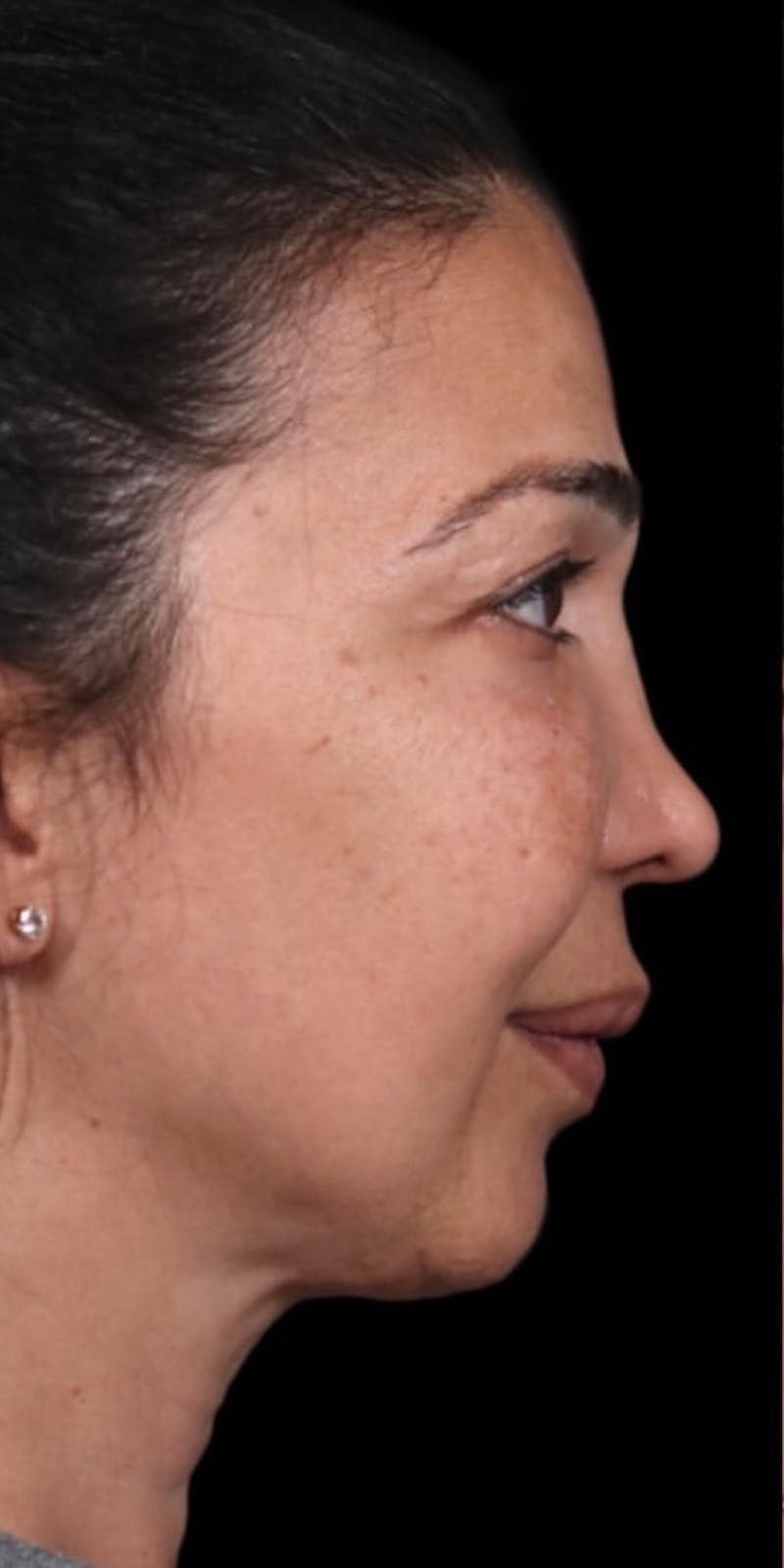 Halo Laser Before & After Gallery - Patient 147538253 - Image 1