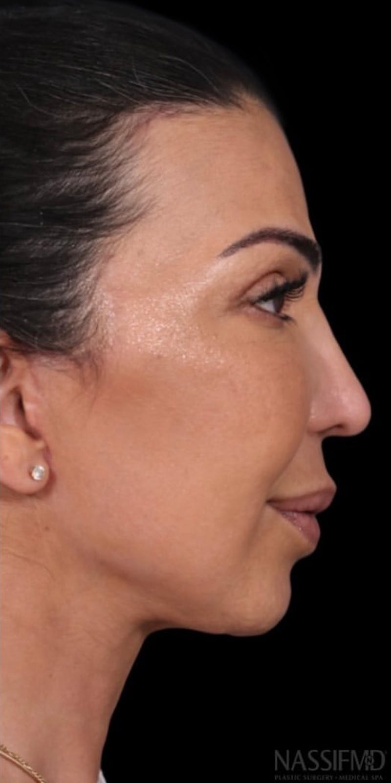 Neck Lift Before & After Gallery - Patient 147538252 - Image 2
