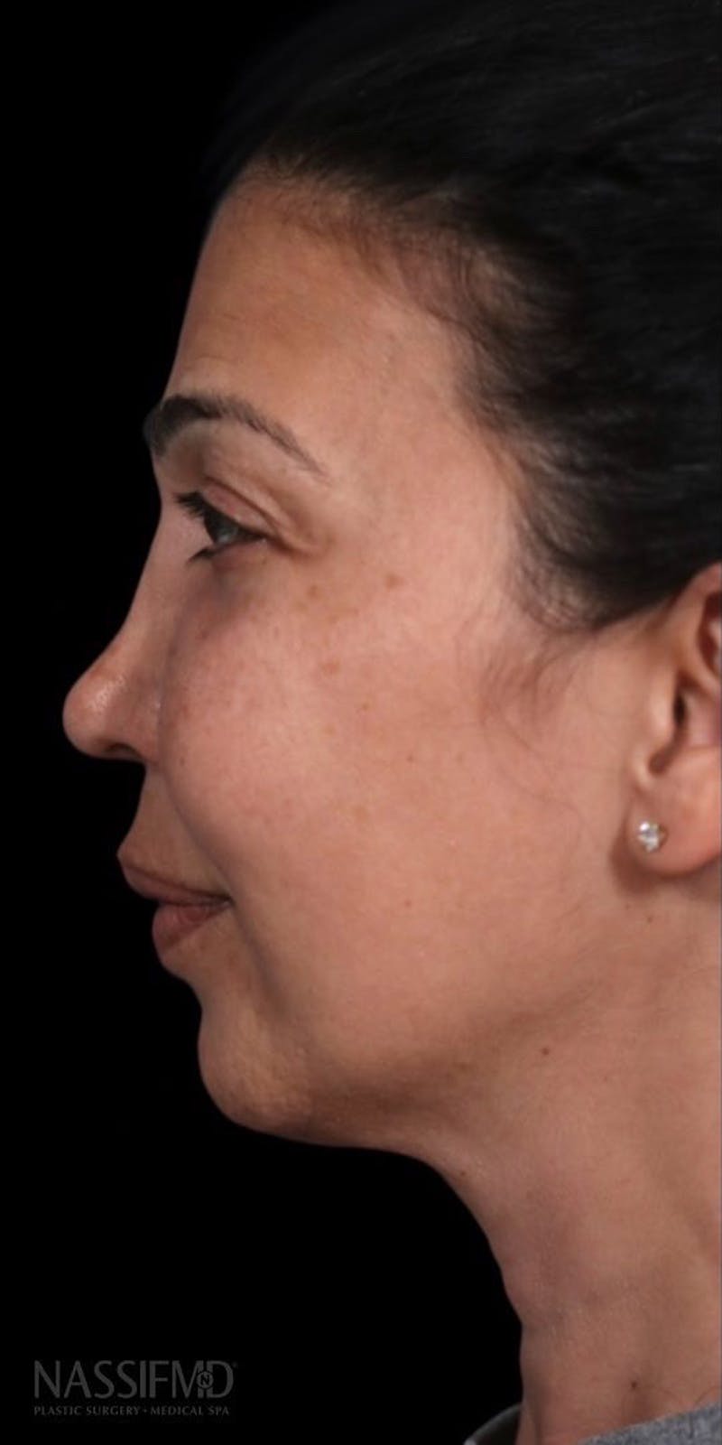 Facelift Before & After Gallery - Patient 147538250 - Image 5