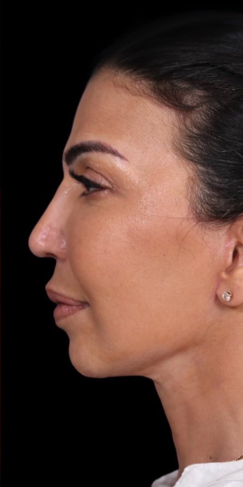 Neck Lift Before & After Gallery - Patient 147538252 - Image 6