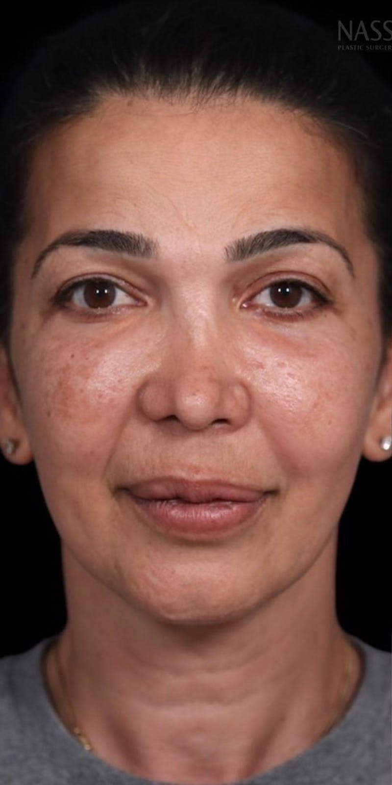 Brow Lift Before & After Gallery - Patient 147538255 - Image 3