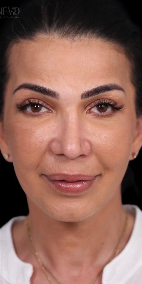 Facelift Before & After Gallery - Patient 147538250 - Image 2