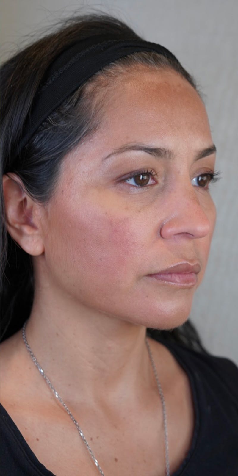 Fillers Before & After Gallery - Patient 147538266 - Image 2