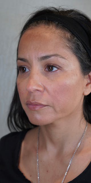 Fillers Before & After Gallery - Patient 147538266 - Image 6