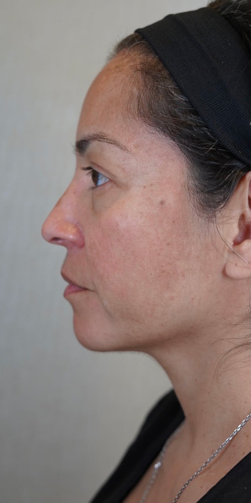 Fillers Before & After Gallery - Patient 147538266 - Image 7