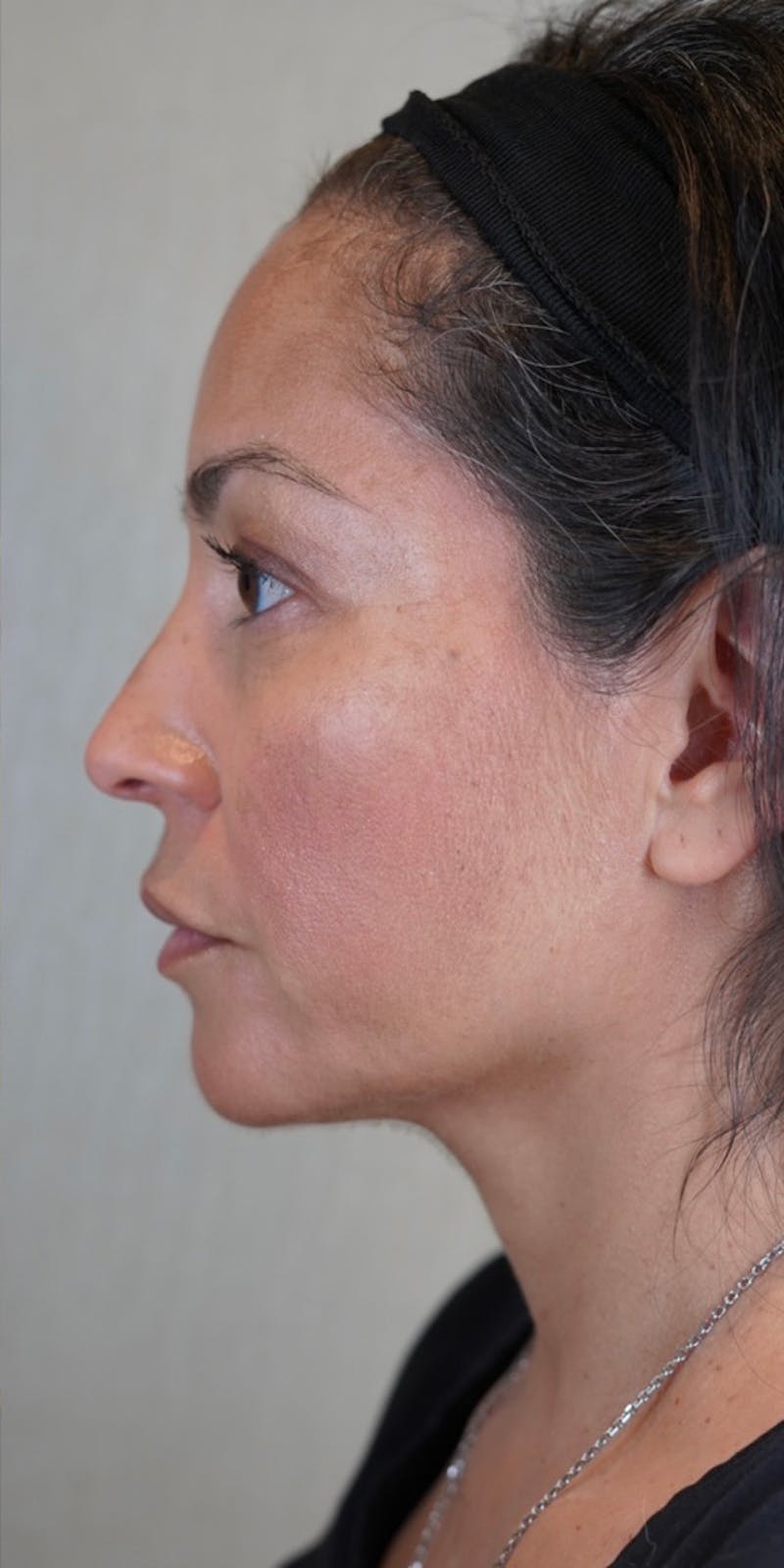 Fillers Before & After Gallery - Patient 147538266 - Image 8