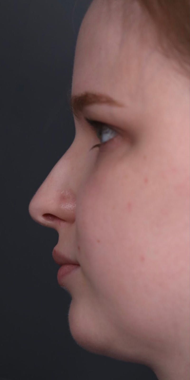 Primary Rhinoplasty Before & After Gallery - Patient 148467451 - Image 5