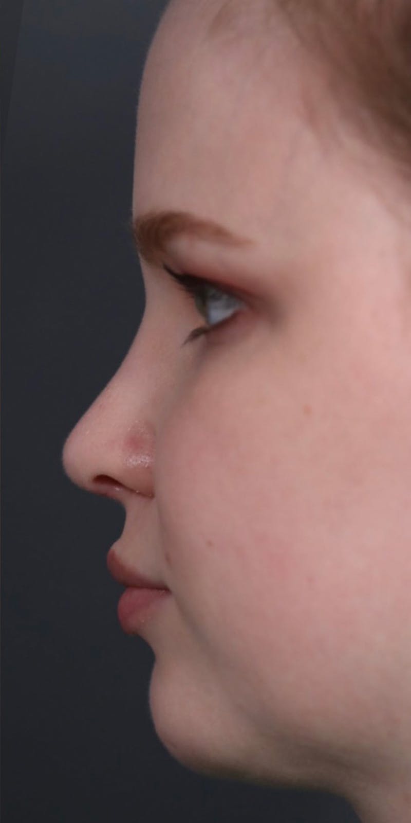 Primary Rhinoplasty Before & After Gallery - Patient 148467451 - Image 6