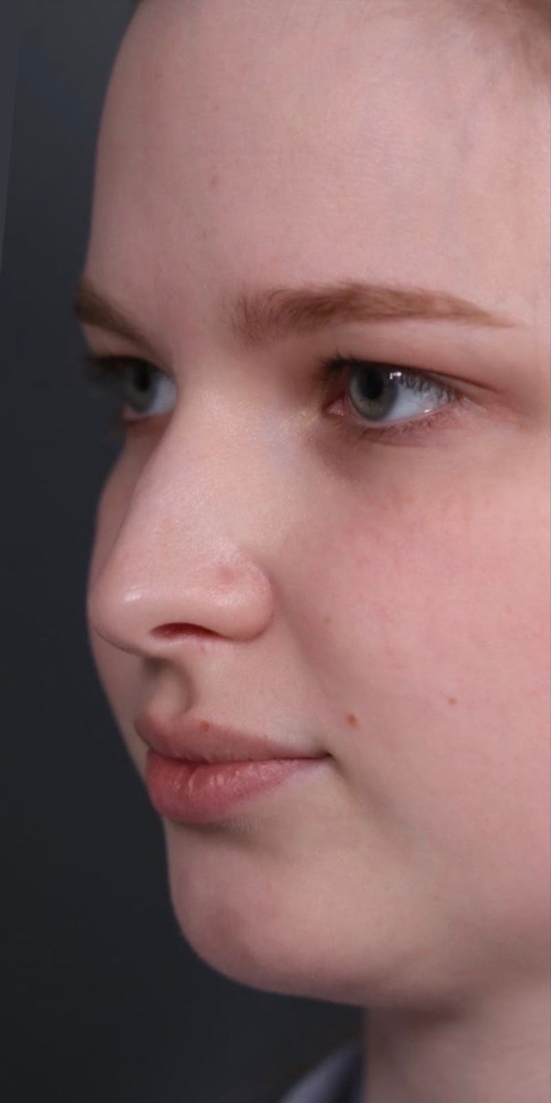 Primary Rhinoplasty Before & After Gallery - Patient 148467451 - Image 7