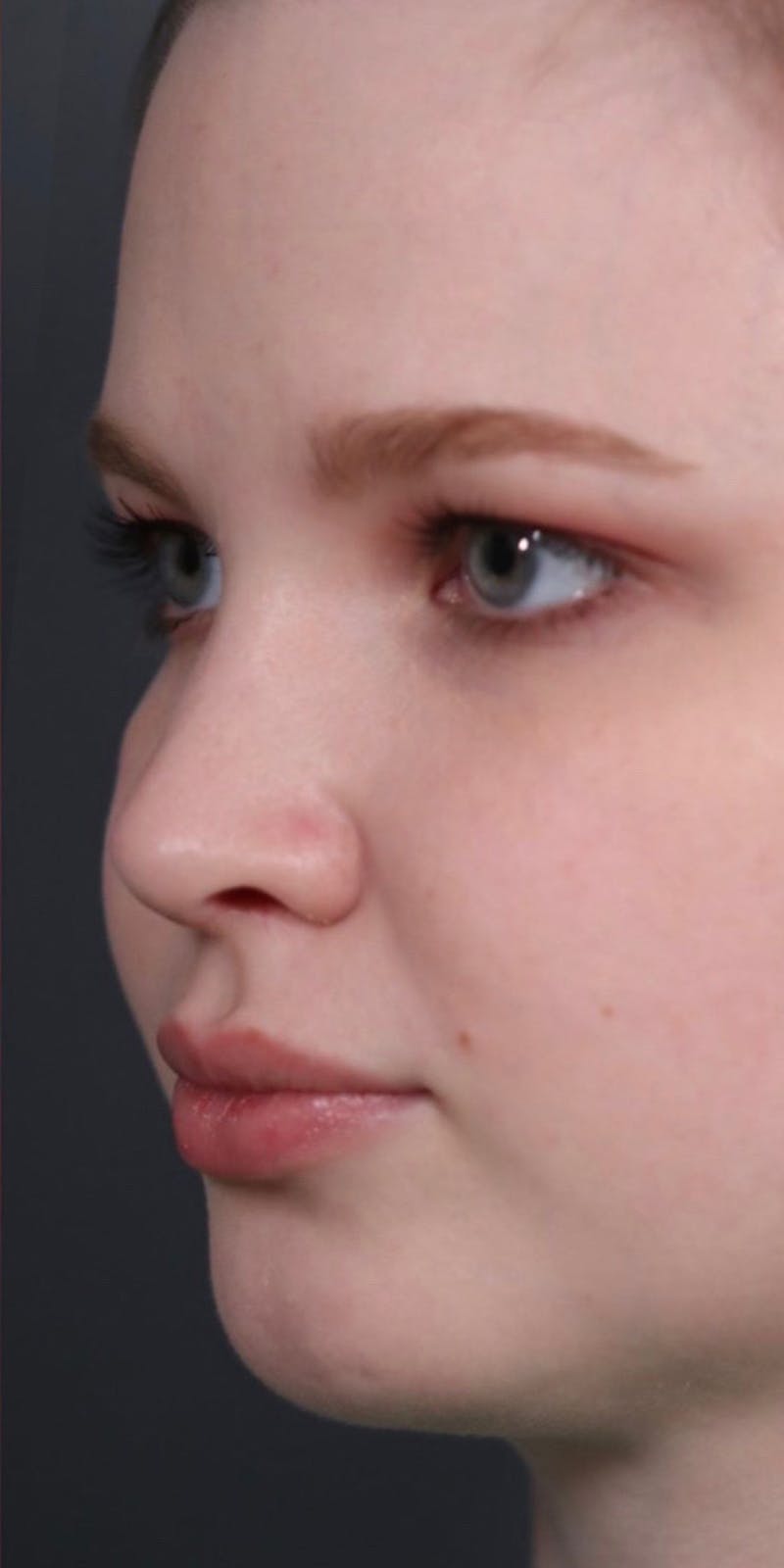 Primary Rhinoplasty Before & After Gallery - Patient 148467451 - Image 8