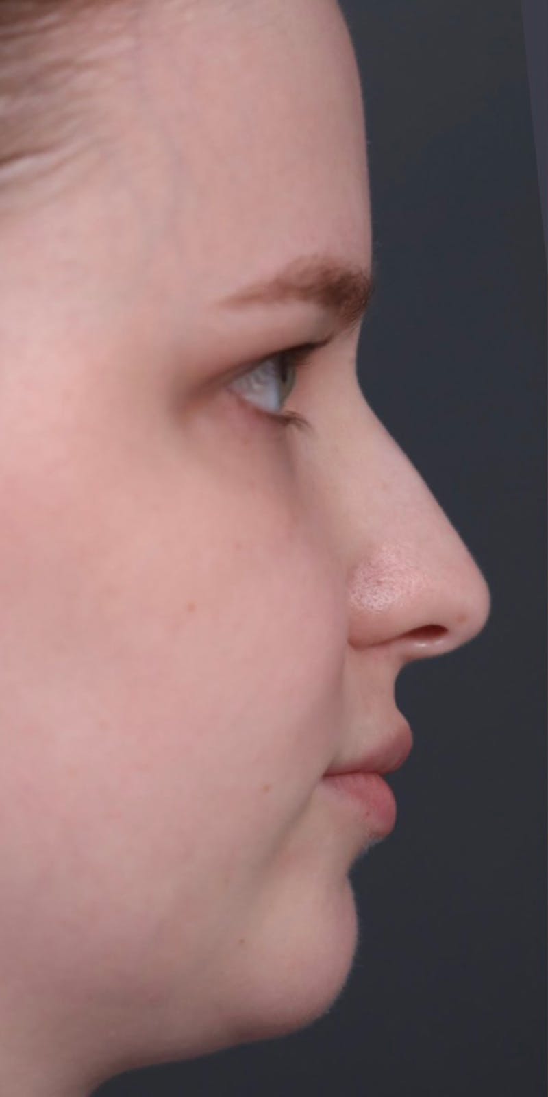 Primary Rhinoplasty Before & After Gallery - Patient 148467451 - Image 1