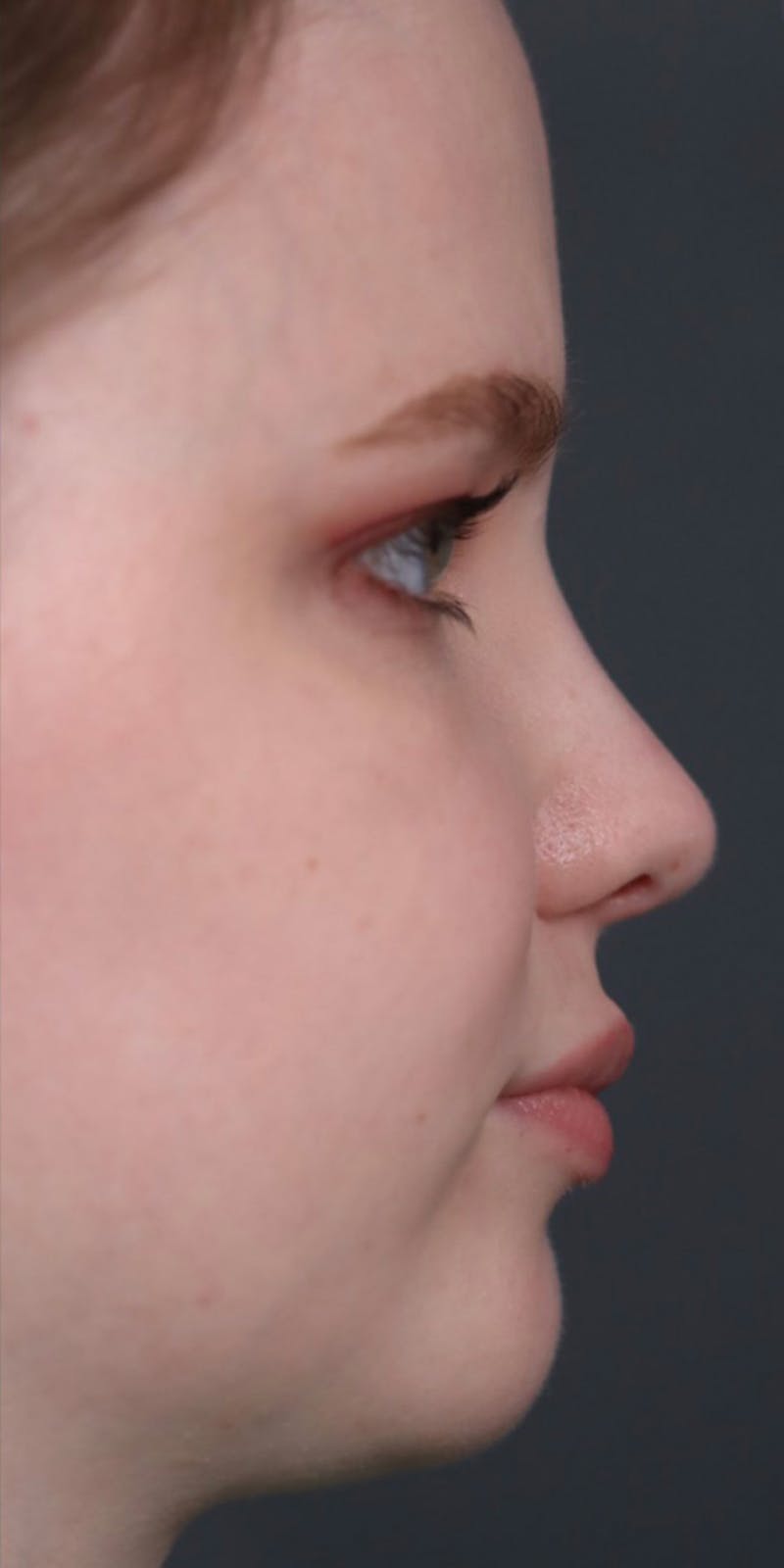 Primary Rhinoplasty Before & After Gallery - Patient 148467451 - Image 2