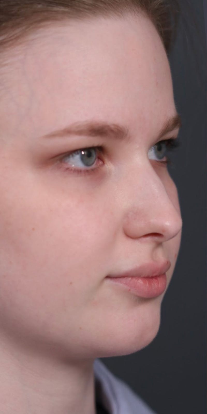 Primary Rhinoplasty Before & After Gallery - Patient 148467451 - Image 9