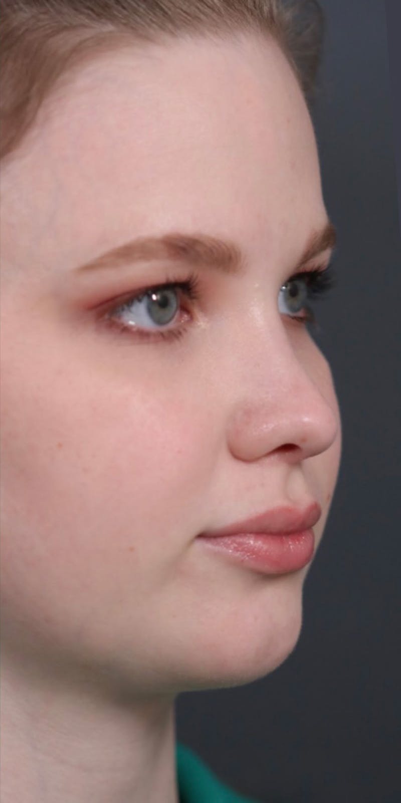 Primary Rhinoplasty Before & After Gallery - Patient 148467451 - Image 10