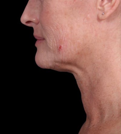 Neck Lift Before & After Gallery - Patient 148467504 - Image 1