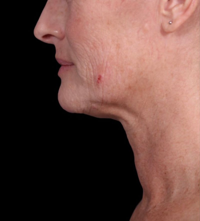 Neck Lift Before & After Gallery - Patient 148467504 - Image 1