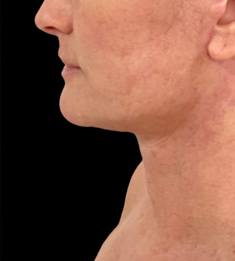 Neck Lift Before & After Gallery - Patient 148467504 - Image 2
