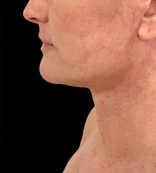 Neck Lift Before & After Gallery - Patient 148467504 - Image 2