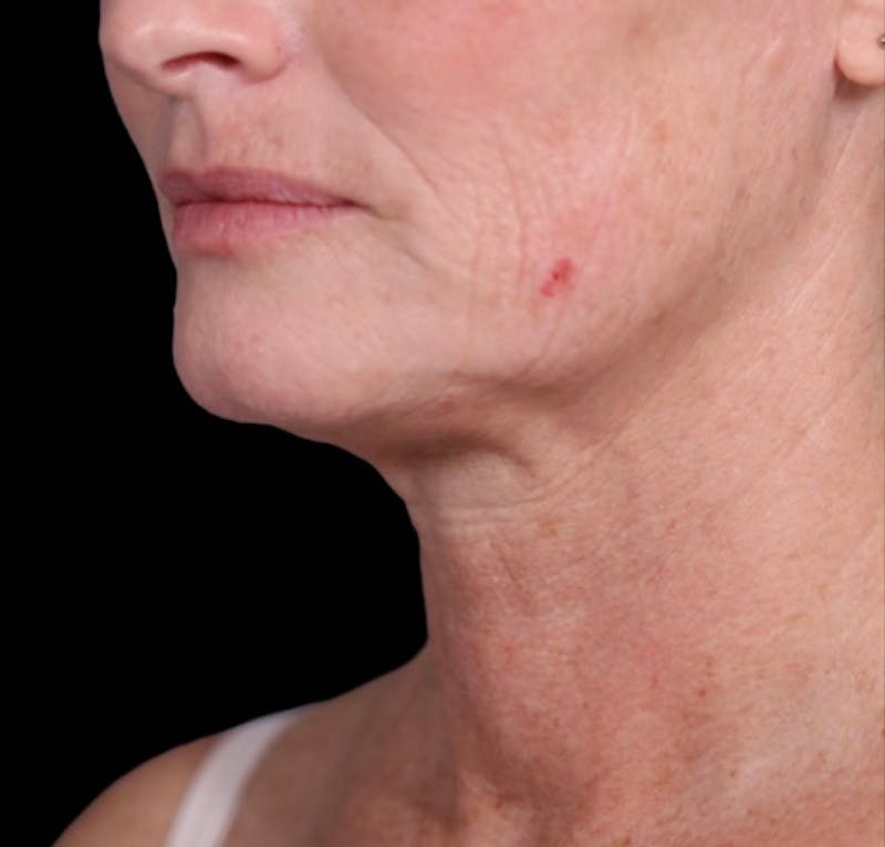 Neck Lift Before & After Gallery - Patient 148467504 - Image 3