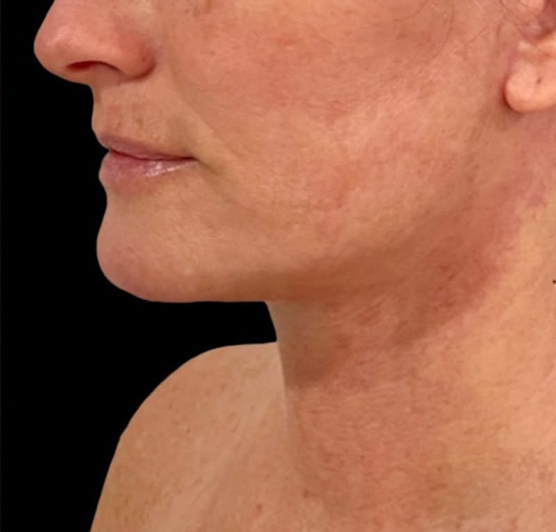 Neck Lift Before & After Gallery - Patient 148467504 - Image 4