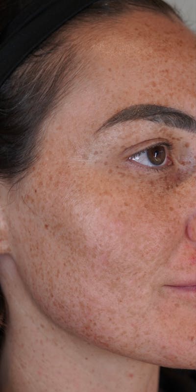 BBL (Broadband Light) Before & After Gallery - Patient 148467513 - Image 1