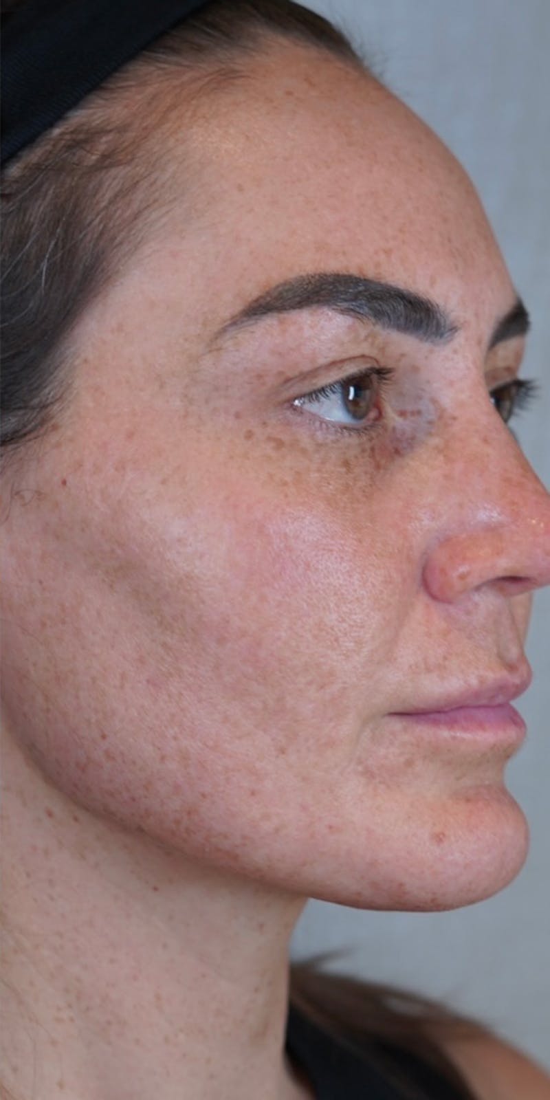 BBL (Broadband Light) Before & After Gallery - Patient 148467513 - Image 4