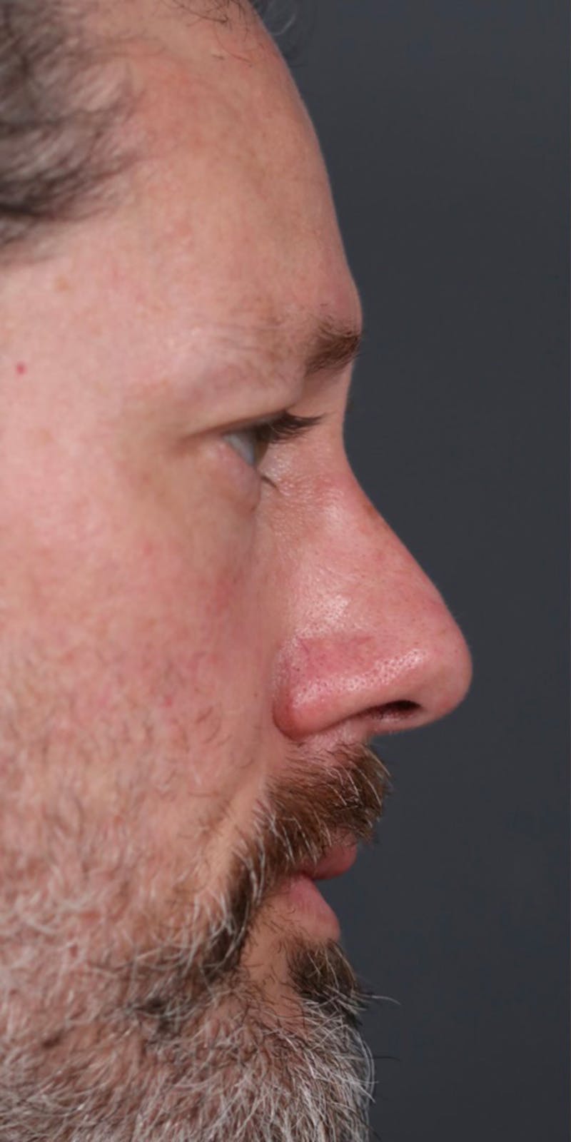 Primary Rhinoplasty Before & After Gallery - Patient 149051202 - Image 1