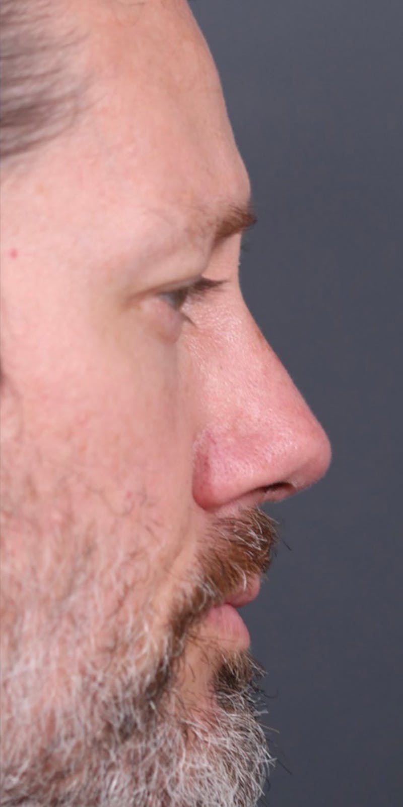 Primary Rhinoplasty Before & After Gallery - Patient 149051202 - Image 2