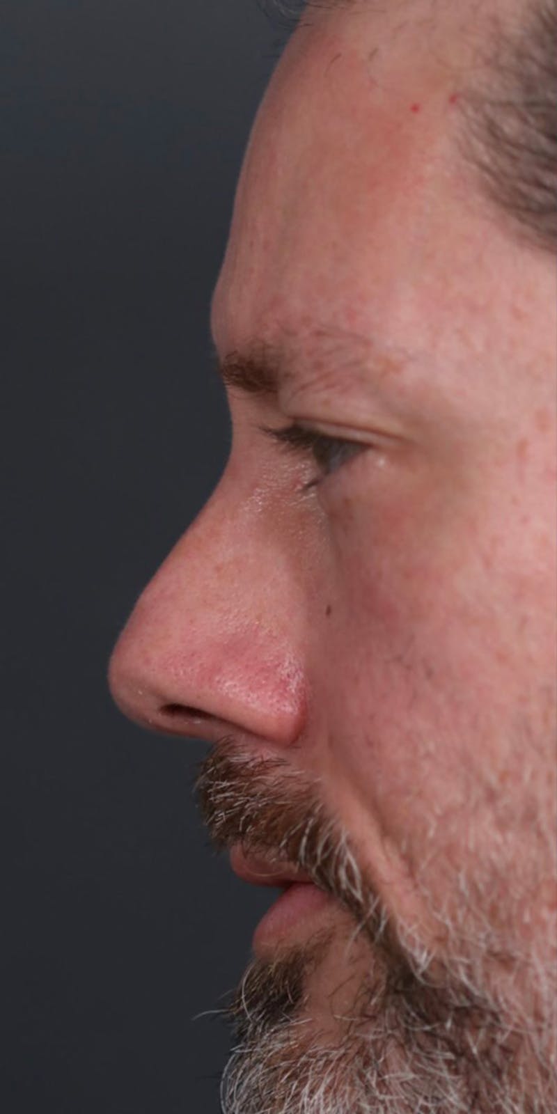 Primary Rhinoplasty Before & After Gallery - Patient 149051202 - Image 3